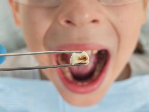 Best Emergency Dental Care for Broken or Chipped Teeth in Joshua Tree, CA